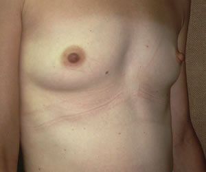 Breast Augmentation Dr. Joel Rein Breast Augmentation Dr. Joel Rein