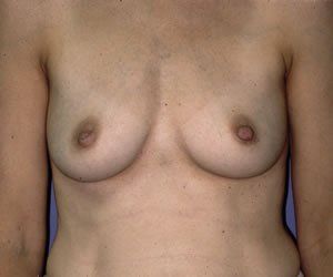 Breast Augmentation Dr. Joel Rein Breast Augmentation Dr. Joel Rein