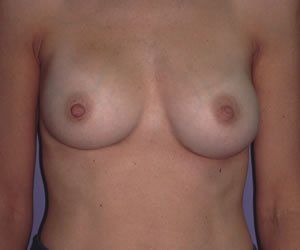 Breast Augmentation Dr. Joel Rein Breast Augmentation Dr. Joel Rein