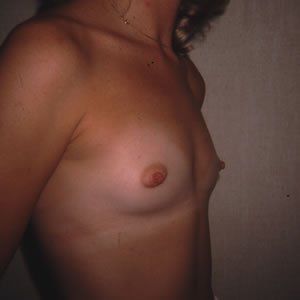 Breast Augmentation Dr. Joel Rein Breast Augmentation Dr. Joel Rein