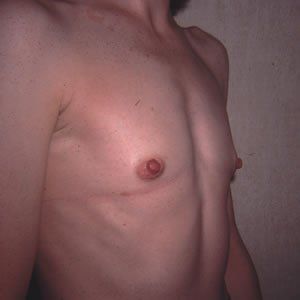 Breast Augmentation Dr. Joel Rein Breast Augmentation Dr. Joel Rein