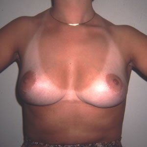 Breast Lift Dr. Joel Rein Breast Lift Dr. Joel Rein