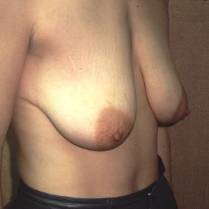 Breast Lift Dr. Joel Rein Breast Lift Dr. Joel Rein