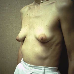 Breast Lift Dr. Joel Rein Breast Lift Dr. Joel Rein
