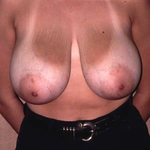 Breast Reduction Dr. Joel Rein