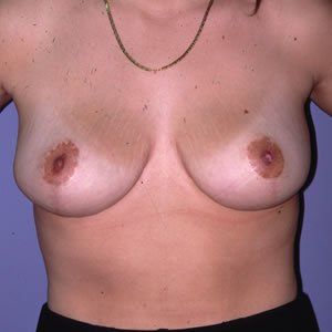 Breast Reduction Dr. Joel Rein