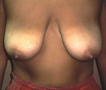 Breast Reduction Dr. Joel Rein