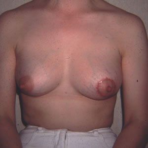 Breast Anomalies Dr. Joel Rein Breast Anomalies Dr. Joel Rein