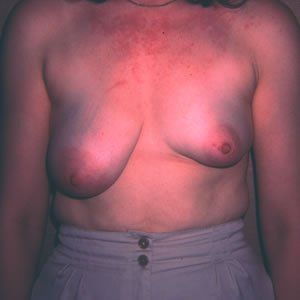Breast Anomalies Dr. Joel Rein Breast Anomalies Dr. Joel Rein