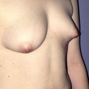 Breast Anomalies Dr. Joel Rein Breast Anomalies Dr. Joel Rein