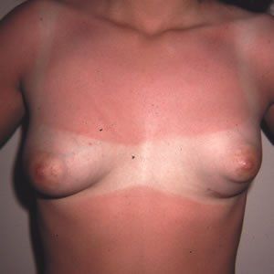 Breast Anomalies Dr. Joel Rein Breast Anomalies Dr. Joel Rein