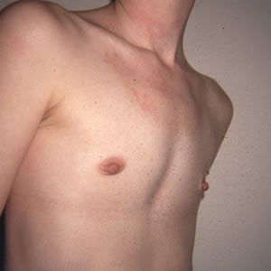 Breast Anomalies Dr. Joel Rein Breast Anomalies Dr. Joel Rein