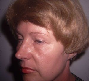 Blepharoplasty Dr. Joel Rein Blepharoplasty Dr. Joel Rein