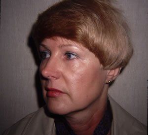 Blepharoplasty Dr. Joel Rein Blepharoplasty Dr. Joel Rein