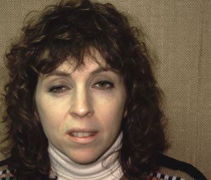 Blepharoplasty Dr. Joel Rein Blepharoplasty Dr. Joel Rein