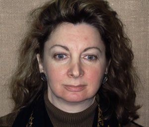 Blepharoplasty Dr. Joel Rein Blepharoplasty Dr. Joel Rein