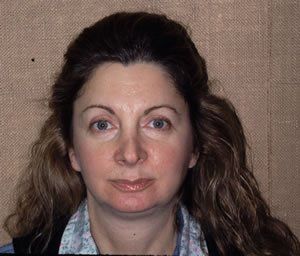 Blepharoplasty Dr. Joel Rein Blepharoplasty Dr. Joel Rein