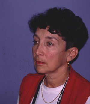 Blepharoplasty Dr. Joel Rein Blepharoplasty Dr. Joel Rein