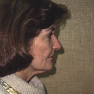 Facelift Dr. Joel Rein Facelift Dr. Joel Rein