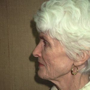 Facelift Dr. Joel Rein Facelift Dr. Joel Rein