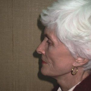 Facelift Dr. Joel Rein Facelift Dr. Joel Rein