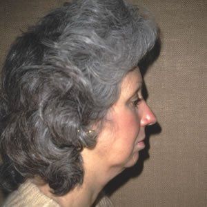 Facelift Dr. Joel Rein Facelift Dr. Joel Rein