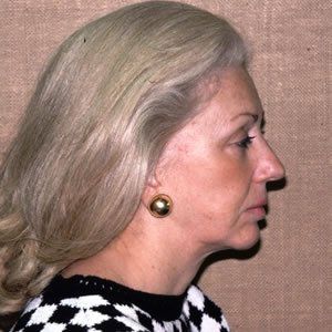 Facelift Dr. Joel Rein Facelift Dr. Joel Rein