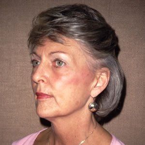 Facelift Dr. Joel Rein Facelift Dr. Joel Rein