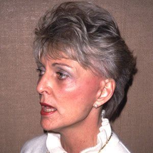 Facelift Dr. Joel Rein Facelift Dr. Joel Rein