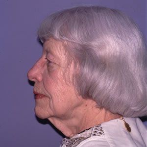 Facelift Dr. Joel Rein Facelift Dr. Joel Rein