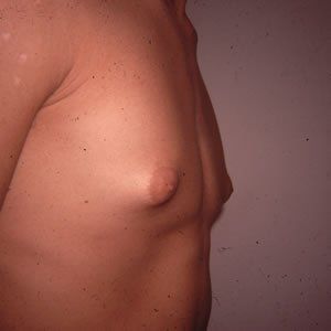 Gynecomastia Dr. Joel Rein Gynecomastia Dr. Joel Rein