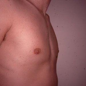 Gynecomastia Dr. Joel Rein Gynecomastia Dr. Joel Rein