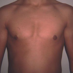 Gynecomastia Dr. Joel Rein Gynecomastia Dr. Joel Rein