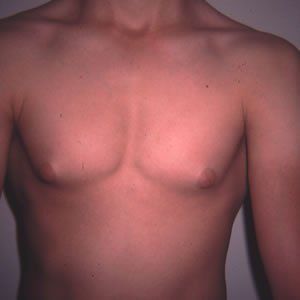 Gynecomastia Dr. Joel Rein Gynecomastia Dr. Joel Rein