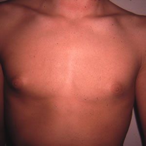 Gynecomastia Dr. Joel Rein Gynecomastia Dr. Joel Rein