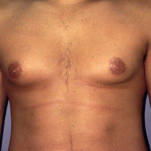 Gynecomastia Dr. Joel Rein Gynecomastia Dr. Joel Rein