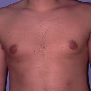 Gynecomastia Dr. Joel Rein Gynecomastia Dr. Joel Rein