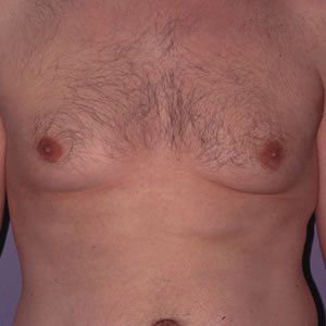 Gynecomastia Dr. Joel Rein Gynecomastia Dr. Joel Rein