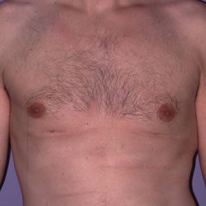 Gynecomastia Dr. Joel Rein Gynecomastia Dr. Joel Rein