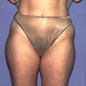 Liposuction Dr. Joel Rein Liposuction Dr. Joel Rein