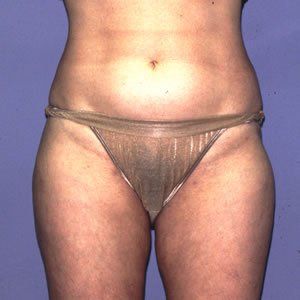 Liposuction Dr. Joel Rein Liposuction Dr. Joel Rein