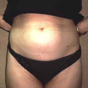 Liposuction Dr. Joel Rein Liposuction Dr. Joel Rein