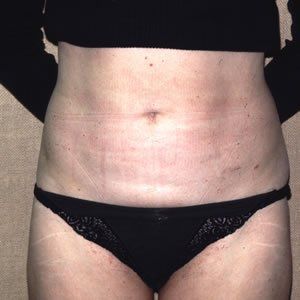 Liposuction Dr. Joel Rein Liposuction Dr. Joel Rein