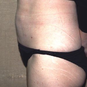 Liposuction Dr. Joel Rein Liposuction Dr. Joel Rein