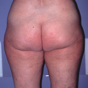 Liposuction Dr. Joel Rein Liposuction Dr. Joel Rein