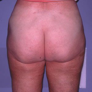 Liposuction Dr. Joel Rein Liposuction Dr. Joel Rein