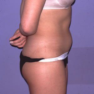 Liposuction Dr. Joel Rein Liposuction Dr. Joel Rein