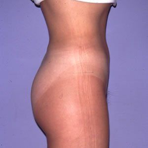 Liposuction Dr. Joel Rein