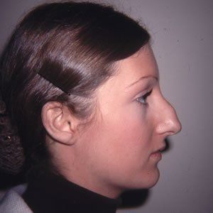 Rhinoplasty Dr. Rein Rhinoplasty Dr. Rein