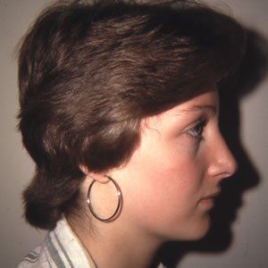 Abdominoplasty Dr. Joel Rein Abdominoplasty Dr. Joel Rein